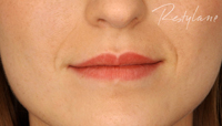 Lip Enhancement London